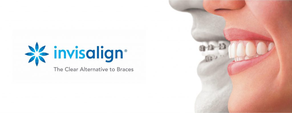 Invisalign the Clear Alternative to Braces