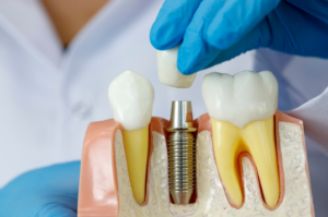 Dental Implant Demo Using a Model to Show Patients the Procedure